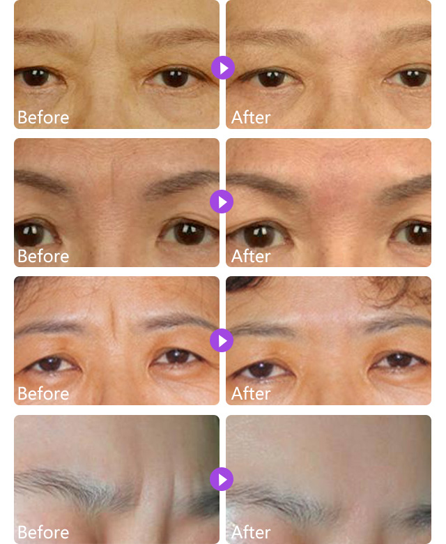 快速有效的方法 点她咨询 对于眉间川字纹还有疑问？看这里！the glabella sichuan
